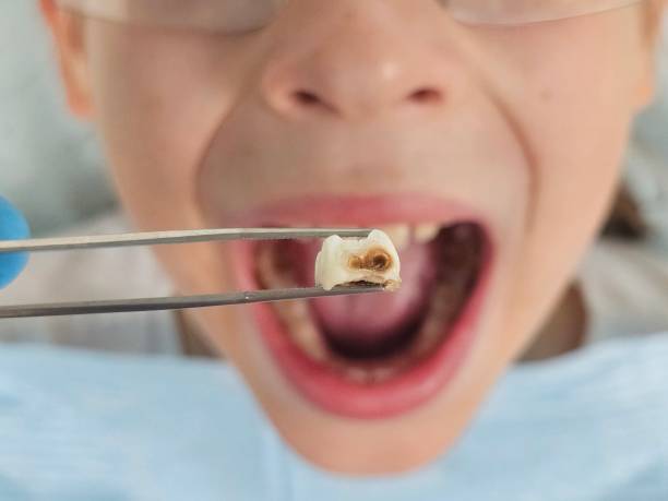Best Emergency Dentist for Lost Fillings or Crowns in Brooklyn, IA